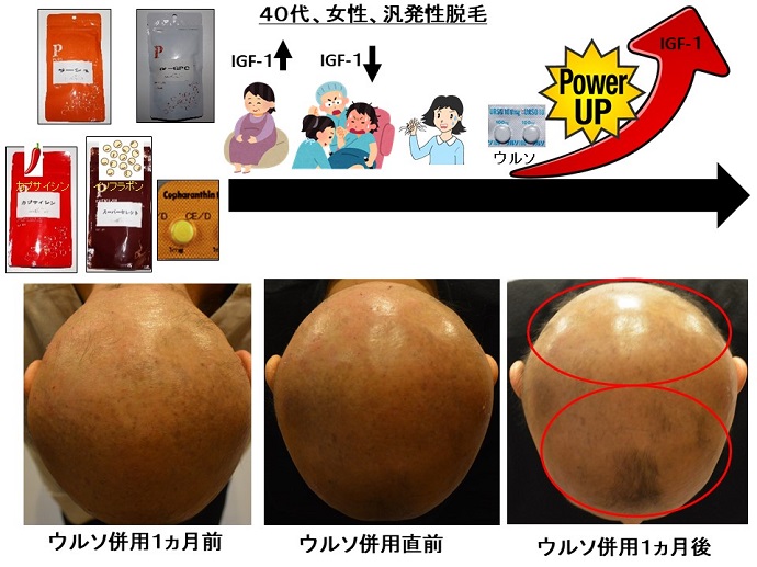円形脱毛症　病院